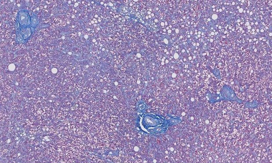 Liver biopsy cells.
