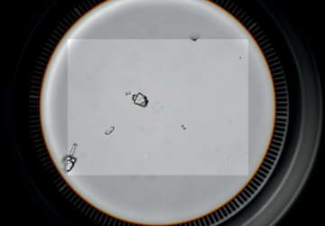 Urine sediment sample as seen under a microscope.