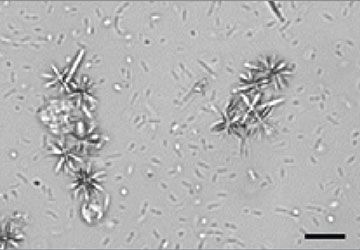 Urine sediment likely drug-related crystals on a slide