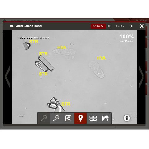 Urine sediment results shown on an ipad.