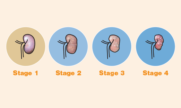 Stage 2 of the IRIS CKD guidelines: staging