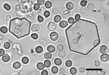 Urine sediment cystine crystals with red blood cells on a slide