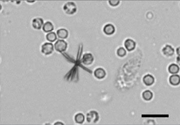 Urine sediment bilirubin crystals with white blood cells on a slide