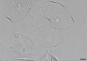 Urine sediment squamous epithelial cells on a slide