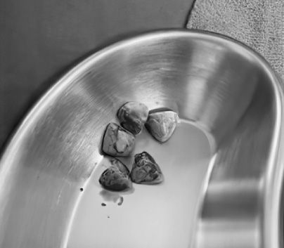 Five large bladder stones in a metal bowl.